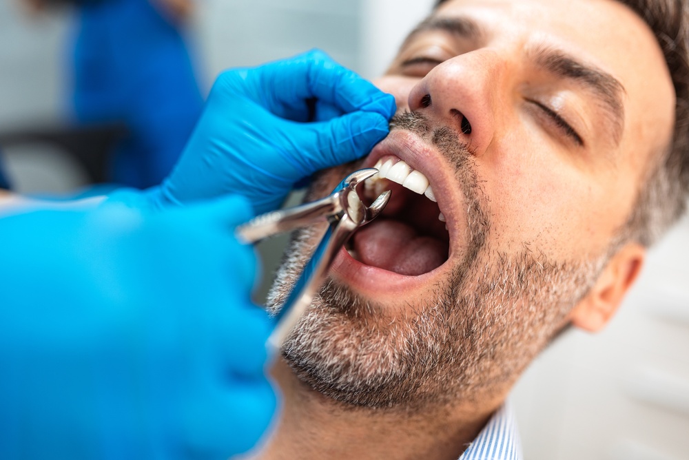 Tooth Extractions in Orange Park Man with a short gray beard and closed eyes leaning back while a dentist in blue gloves uses dental forceps during a tooth extraction visit in Orange Park